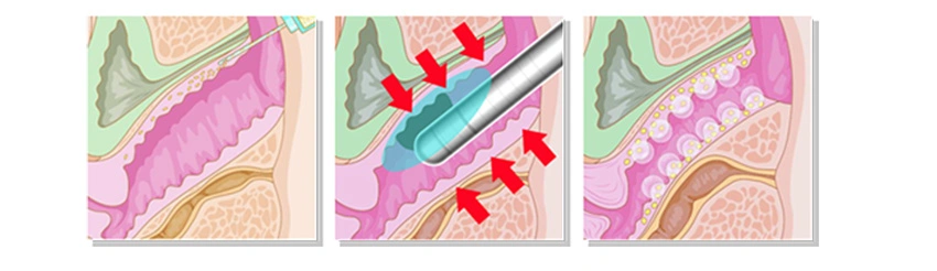 Quick Effect Face Tightening Transducer Machine Hifu Vaginal Tighten