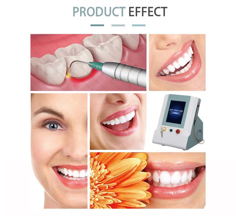 Dental Laser Treat Apthous Ulcer Dental Soft Tissue Laser