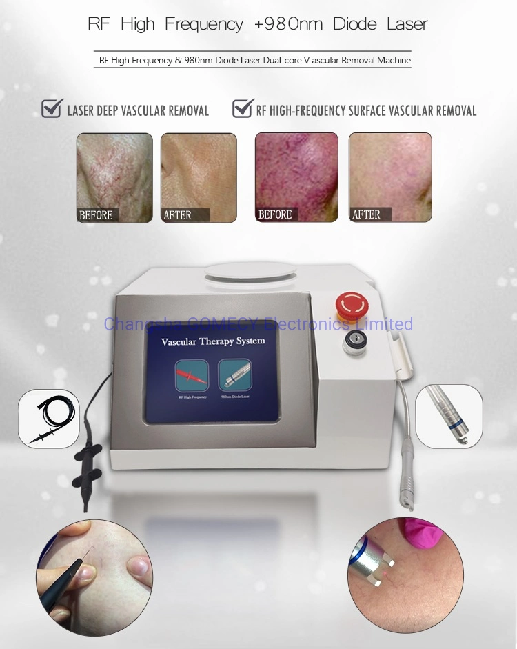 980nm RF Diode Laser Vascular Removal Spider Vein Vascular Removal machine