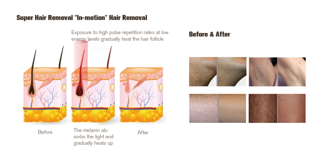 Newest Promotion Elight Hair Removal Big 100% Good Feedback IPL Handle