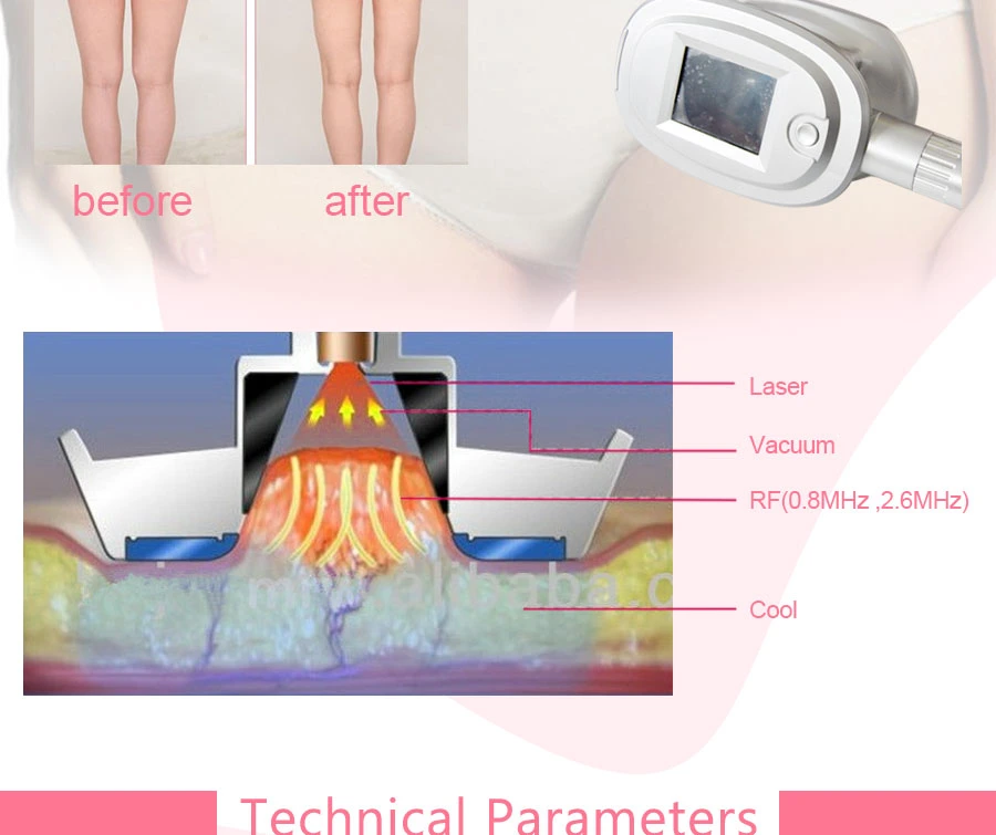 Multi-Function Cryolipolysis Laser RF Vacuum Cellulite Reduction Beauty Machine