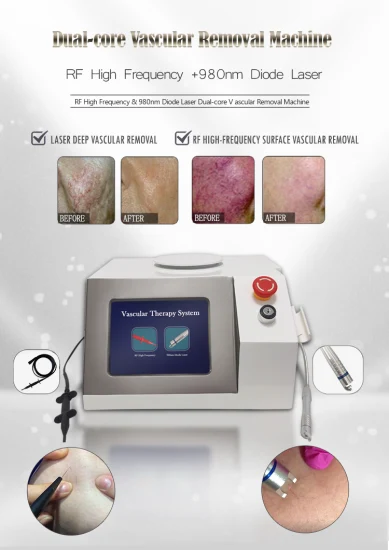 980nm RF Diode Laser Vascular Removal Spider Vein Vascular Removal machine